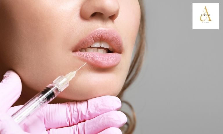 Natural-looking lip filler results at Aurum Aesthetic Clinic, Delhi