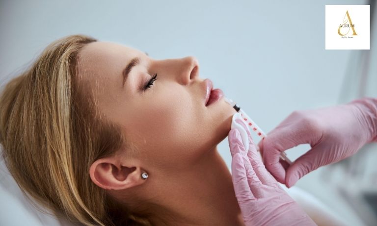 Natural lip enhancement result after dermal filler consultation