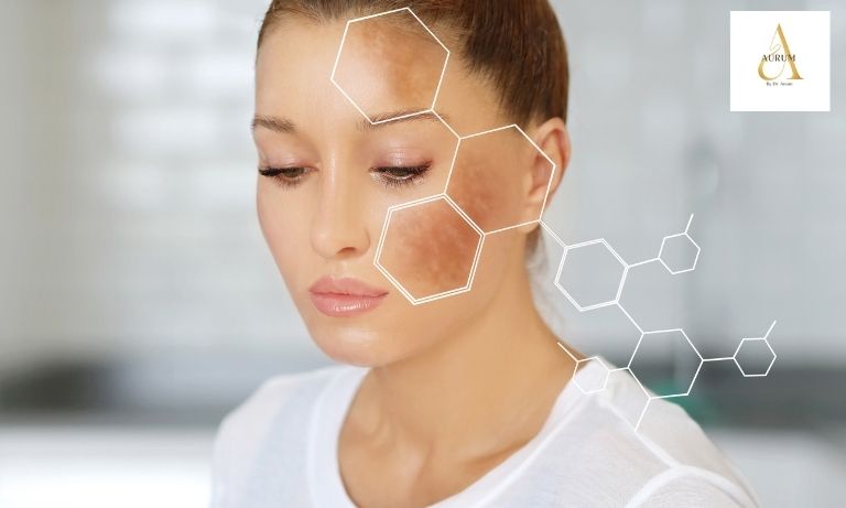 Before and after results of pigmentation treatment at a Punjabi Bagh skin clinic