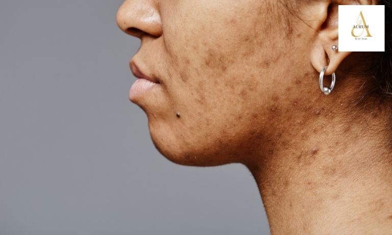 Person applying broad-spectrum SPF sunscreen to prevent pigmentation recurrence