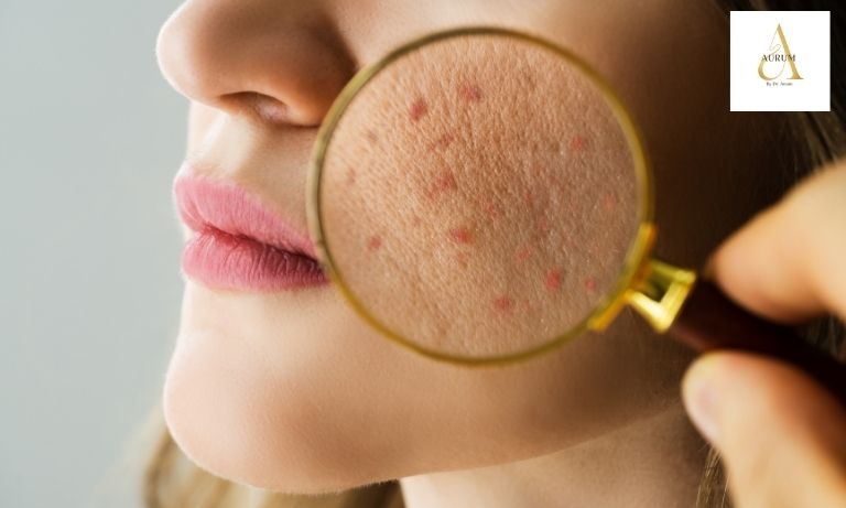 Chemical peel treatment for acne scars at Aurum clinic, Delhi
