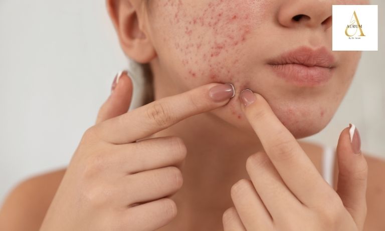 Diagram showing acne scar types on Indian skin tone