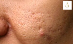 What Type of Acne Scar Treatment in Punjabi Bagh Matches the Type of Scar You Actually Have?
