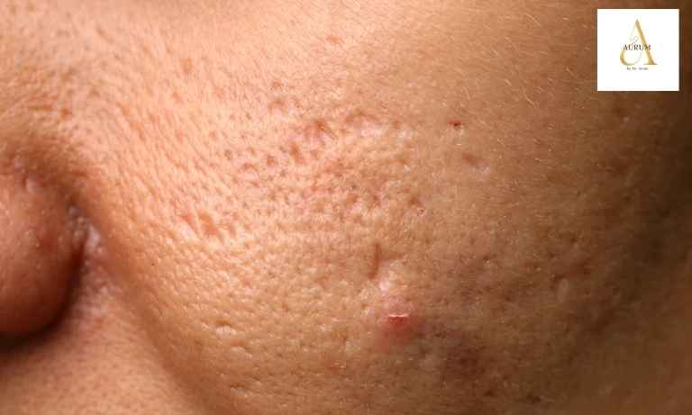 Acne scar treatment consultation at Aurum by Dr Anam in Punjabi Bagh