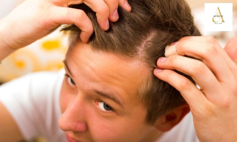 Hair fall recurrence consultation at Aurum by Dr Anam in Punjabi Bagh