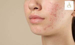 Acne Scar Treatment in Punjabi Bagh | Aurum by Dr Anam