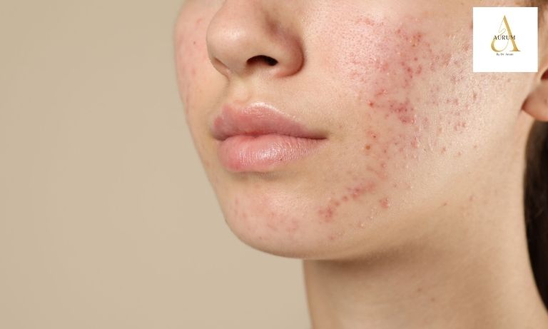 Acne scar treatment consultation with Dr Anam at Aurum in Punjabi Bagh