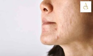 Pigmentation vs Acne Marks: Why Your Treatment Is Probably Wrong