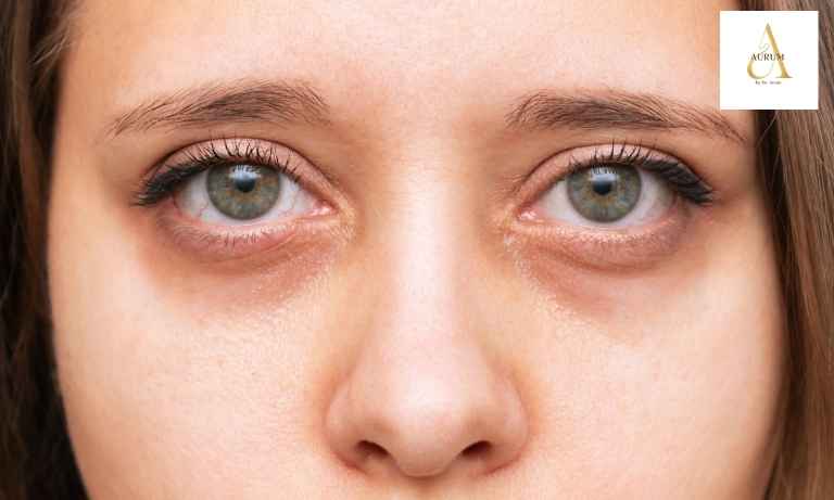 Diagram showing the three main causes of dark circles