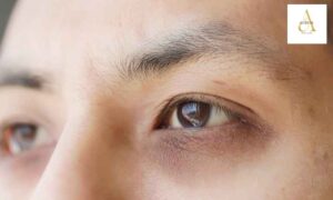 Why Do Dark Circles Come Back Even After Treatment?