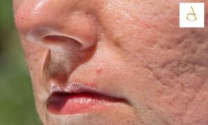 Acne Scar Treatment in Punjabi Bagh – Smooth Skin Solutions