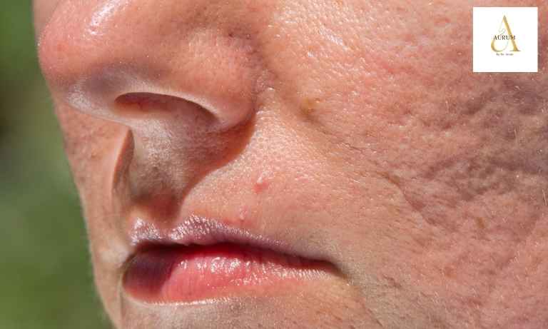 Acne scar treatment consultation at Aurum by Dr Anam in Punjabi Bagh