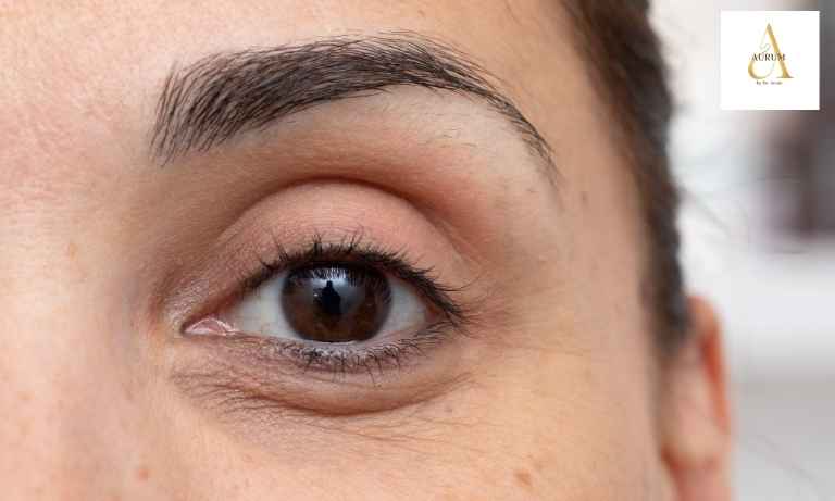Under eye dark circle consultation at Aurum by Dr Anam in Punjabi Bagh