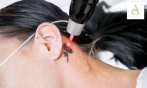 Q Switch Laser (Tattoo Removal) in Punjabi Bagh: Procedure, Benefits, Cost & Results